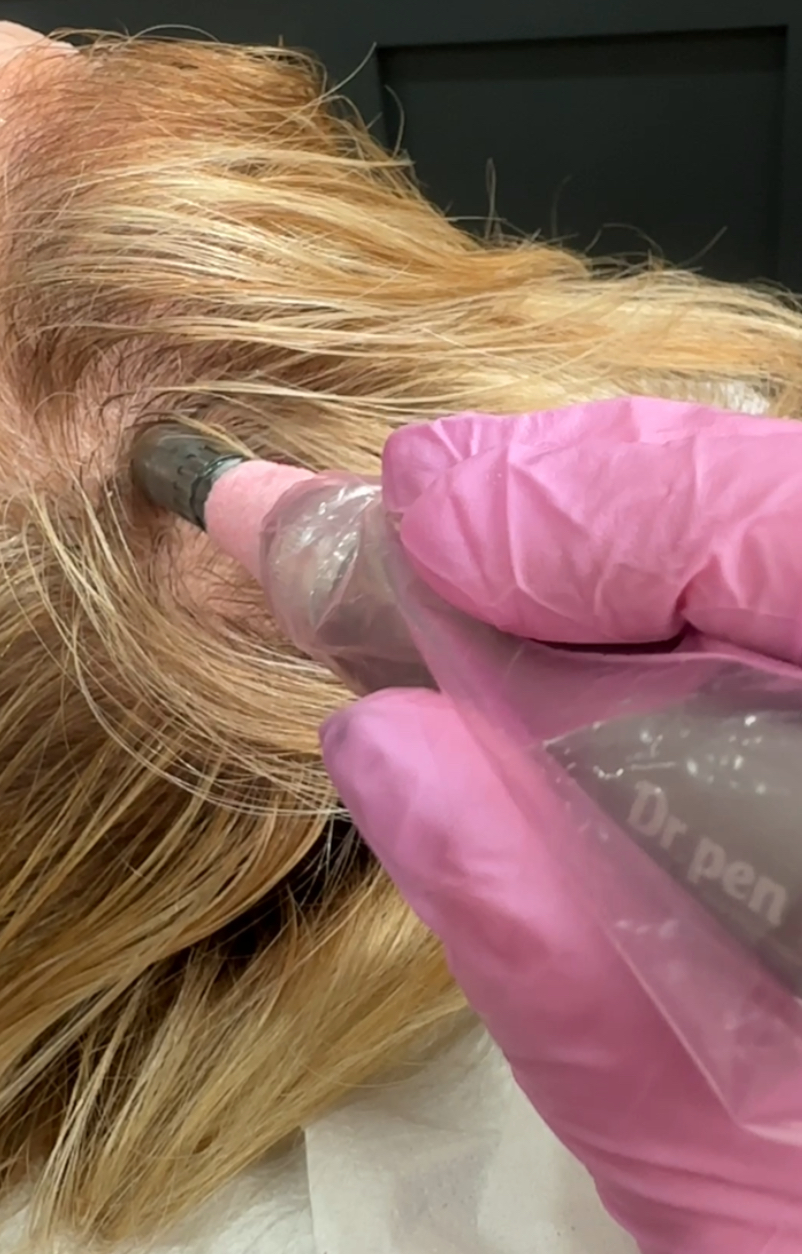IMG_5171 2 Nucleofill hair